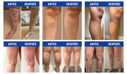 Varicose Veins Spray - ¡Adios Venas!