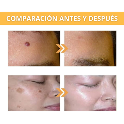 Eliminador de Verrugas Spray - Tag Recede