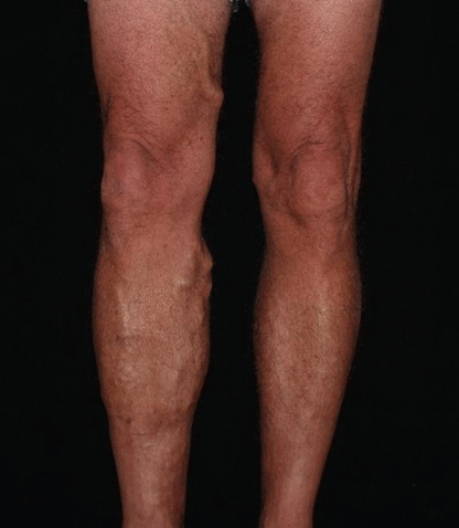 Varicose Veins Spray - ¡Adios Venas!